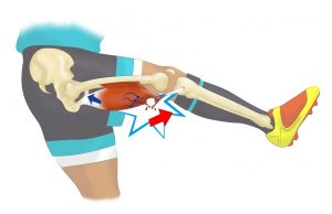 Comment soigner une déchirure musculaire ?